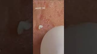 Pimple Popping Pickel ausdrücken  Blackheads entfernen amp Akne Behandlung 1 [upl. by Warner834]