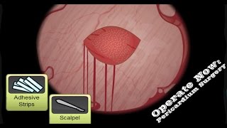 Operate Now Pericardium Surgery Walkthrough [upl. by Eelirem866]