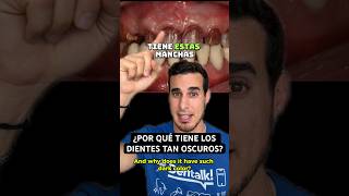 DIENTES de TETRACICLINA  ¿Por qué algunas personas tienen los DIENTES así de OSCUROS con MANCHAS [upl. by Idnahs]