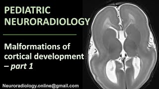 Pediatric Neuroradiology  Malformations of Cortical Development part 1 [upl. by Ohploda]