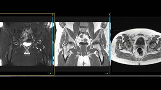 Bilateral avascular necrosis AVN of hips in 33 year old [upl. by Ulysses]