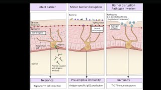 Mystery diagnosis Langerhans cell histiocytosis [upl. by Nomelihp]