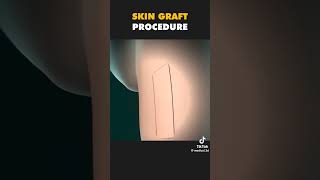 Skin graft procedure biology humanbody medical physiology bodysystem science [upl. by Anahsak]