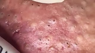 Blackheads amp Whiteheads Satisfying Removal 0275 [upl. by Yssep]