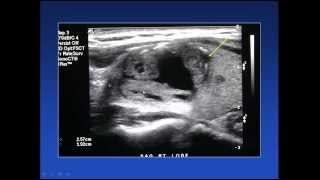 2015 AOCR Radiology Case Review Thyroid Ultrasound [upl. by Leind]