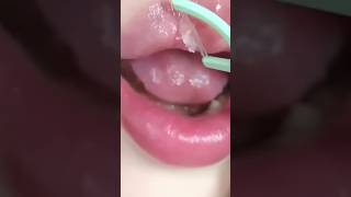 How to remove dead cell in ur lip Winter needs deadcells shorts [upl. by Yrallih]