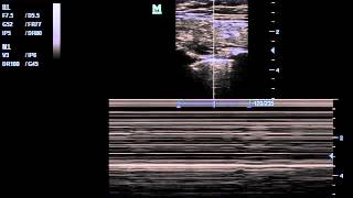 Tension Pneumothorax life by M mode [upl. by Jehias]