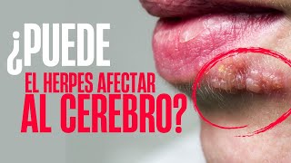 ¿El HERPES puede afectar al CEREBRO ENCEFALITIS HERPÉTICA [upl. by Enotna]