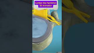 Lumbar Disc Herniation Causes Symptoms amp Treatment  Back Pain Reliefbackpain herniateddisc [upl. by Eniamrahs]