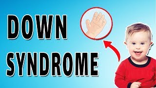 Down Syndrome Features [upl. by Lulita]