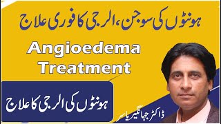 Honton ki allergy ka ilaj  How to Get Rid of Swollen Lips  Angioedema Treatment in Urdu [upl. by Heffron23]