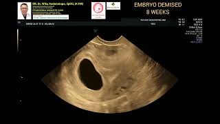 Embryo demised 8 weeks [upl. by Montagna]