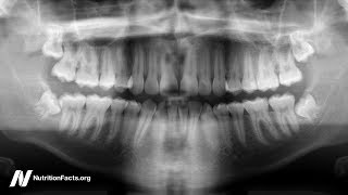 How to Treat Periodontitis with Diet [upl. by Eiramrebma24]