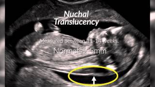 Diagnosis of Down Syndrome [upl. by Aidam]