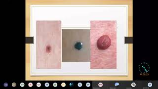 Nevus  Skin Pathology Complete  MBBS Lecture [upl. by Lebar]