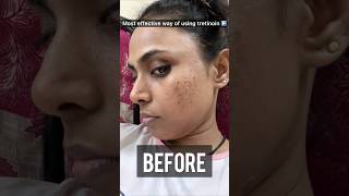 How to use Tretinoin Cream for most effective results Tretinoin before and after skin ✨shots [upl. by Llerrem]