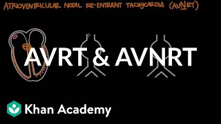 Atrioventricular reentrant tachycardia AVRT amp AV nodal reentrant tachycardia AVNRT [upl. by Phira]