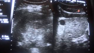 ULTRASOUND CYST vs SOLID MASS [upl. by Aicenet]