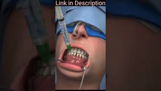 Jaw surgery orthognathic  corrective jaw surgery orthognathic  shorts viral health [upl. by Jacobba]