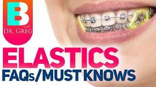 Braces Elastics  Rubber Bands – 5 Most Common Questions [upl. by Ataga]