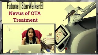 Nevus of OTA Treatment in Delhi India  Tvak Laser Clinic  Dr Jaishree  Dermatologist in Delhi [upl. by Ahsinej]