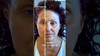 PDO Thread Lift Before and After Nonsurgical Facelift PCH MedSpa Newport Beach [upl. by Guillermo]