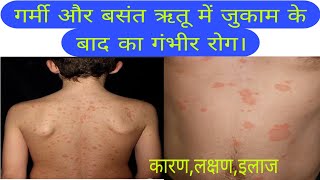 जुकाम के बाद छाती और पीठ का गंभीर रोग कारण इलाज pityriasis rosea disease causessymptomstreatment [upl. by Kerr]