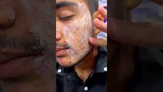 Glow amp Clean Anti Acne Cream Amazing Result youtubeshorts [upl. by Fax35]