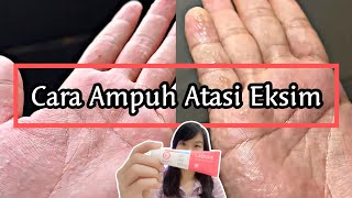 AKHIRNYA NEMU SKINCARE YANG AMPUH ATASI EKSIMKU‼️  EKSIM DISHIDROSIS  POMPHOLYX [upl. by Maegan]