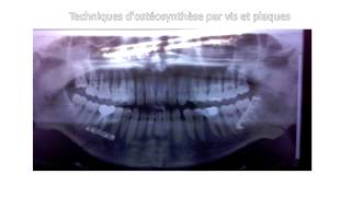 Bases anatomique du traitement des fractures mandibulaires [upl. by Lyman]