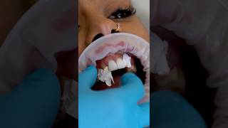 StepbyStep Guide for a Perfect Smile in 2024  Veneers placement 😁✨asmr cosmeticdentistry [upl. by Kcirderfla305]