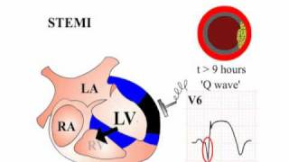 ECG Interpretation  STEMI Section 3 Part 2 [upl. by Akilat]