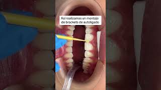 Anímate a iniciar tu tratamiento de ortodoncia con brackets de autoligado 💙 [upl. by Leicester]