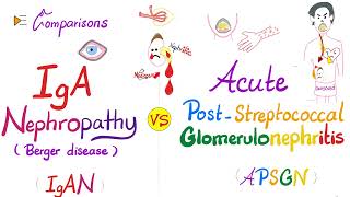 IgA Nephropathy IgAN vs Acute PostStreptococcal Glomerulonephritis APSGN [upl. by Tannen]