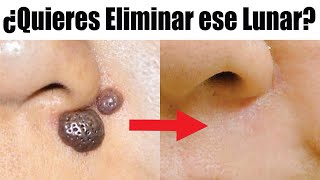 Cómo ELIMINAR LUNARES 💋 VERRUGAS SIRINGOMAS y ACROCORDONES 😊 ETERNA JUVENTUD ESTETIC CENTER [upl. by Mesics]