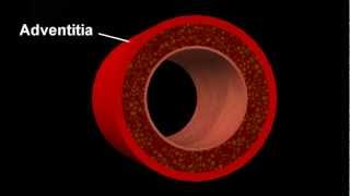 Atherosclerotic disease [upl. by Novyad]