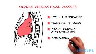 General Surgery – Mediastinal Mass By Rishindra M Reddy MD [upl. by Onder69]