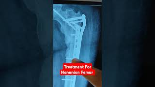 Treatment For Nonunion Femur Dr Sai Chandra Whats App 9573517107 [upl. by Wilterdink]