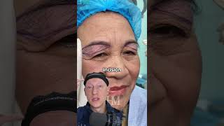 Unconventional Blepharoplasty  Plastic Surgeon Reacts [upl. by Ellis722]