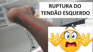 RUPTURA DO TENDÃO DE AQUILES  PARTE 2 [upl. by Sedgewake663]