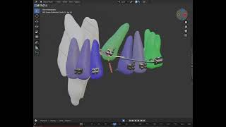 Treat an impacted canine with minimum side effect on adjacent teeth using simulation software [upl. by Anirrehs]