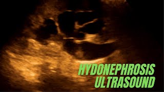 How to diagnose renal Hydronephrosis on ultrasound [upl. by Anotal]