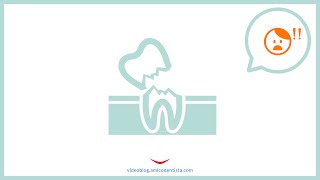 Denti che si rompono in seguito a devitalizzazione [upl. by Slen]