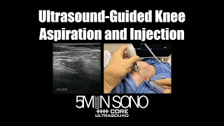 UltrasoundGuided Knee Aspiration and Injection A StepbyStep Guide [upl. by Damalus]