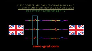 Electrocardiography  First Degree Atrioventricular Block And Intermittent Right Bundle Branch Block [upl. by Rhodie302]