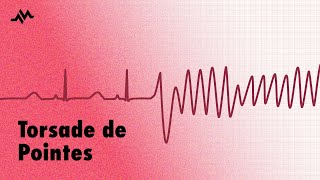 Torsade de Pointes  EKG ECG Interpretation [upl. by Adalie]