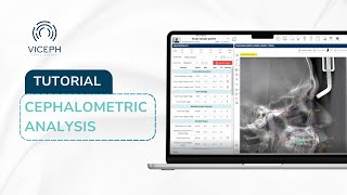 HOW TO USE VICEPH  AIPOWERED CEPHALOMETRIC ANALYSIS [upl. by Ivana]