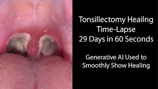 Healing Time Lapse After Tonsillectomy 029 Days in 60 Seconds [upl. by Ennoval]