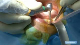 La pose dun implant en pratique [upl. by Revert]