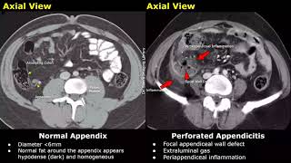 Appendix CT Scan Normal Vs Appendicitis Images  Acute Gangrenous Types amp Perforated Appendix [upl. by Poyssick178]